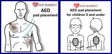 Proper AED Pad Placement